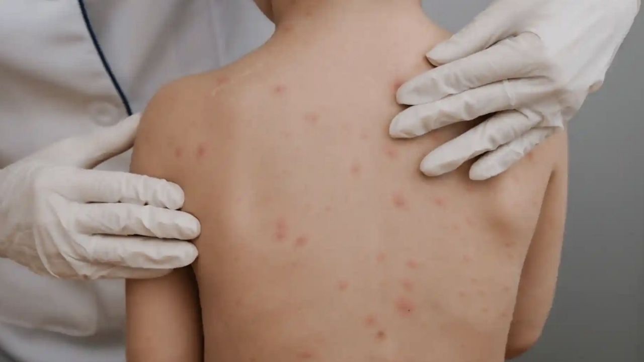 ALERTA en secundaria de Hermosillo por casos de varicela: ¿Qué recomienda Salud Sonora?