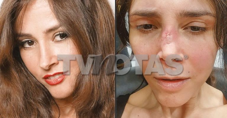 Dorismar acaba desfigurada tras mala cirugía estética