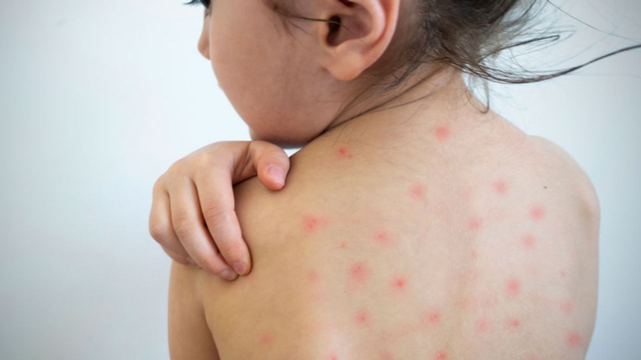 Bebé de seis meses se convierte en el tercer caso confirmado de sarampión en Tlaxcala