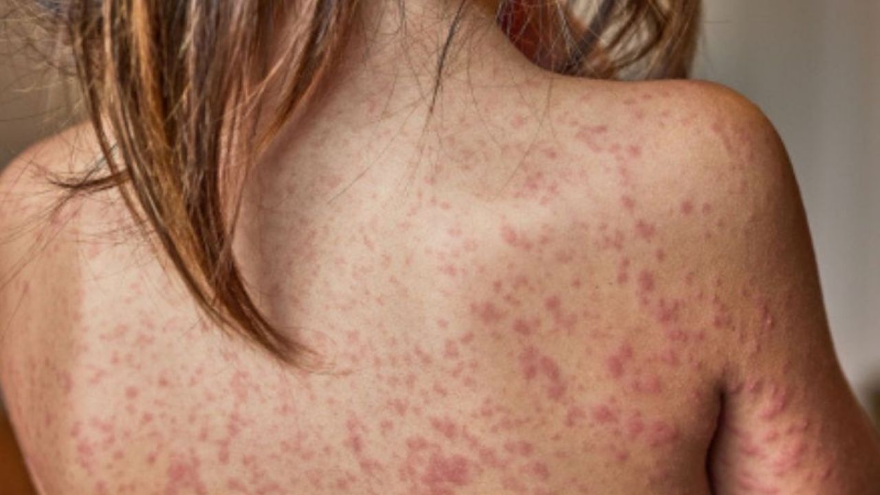 Sarampión supera los 10 mil casos en México; el brote ha causado 31 fallecimientos en el país