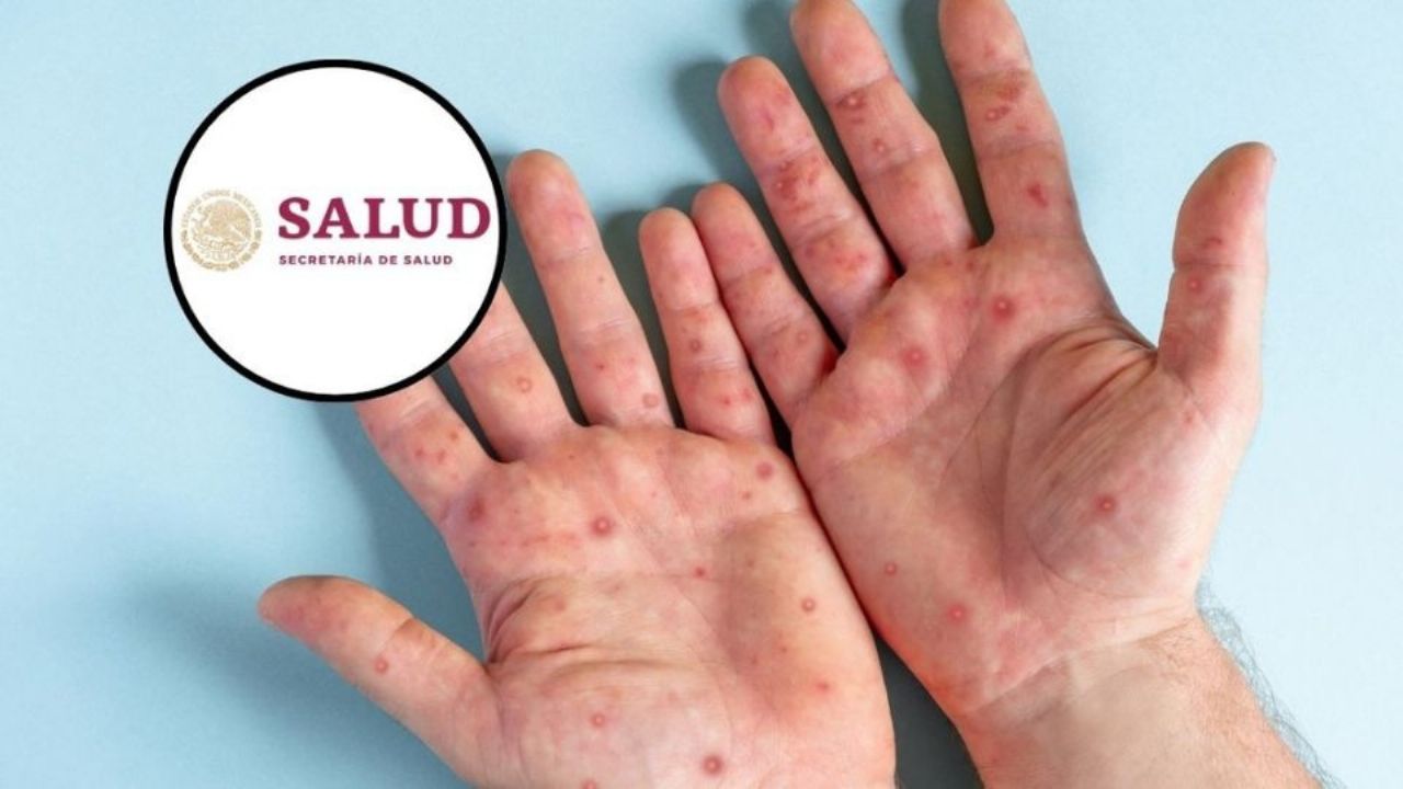 Se registran más de dos mil casos confirmados de sarampión en México en lo que va de 2026