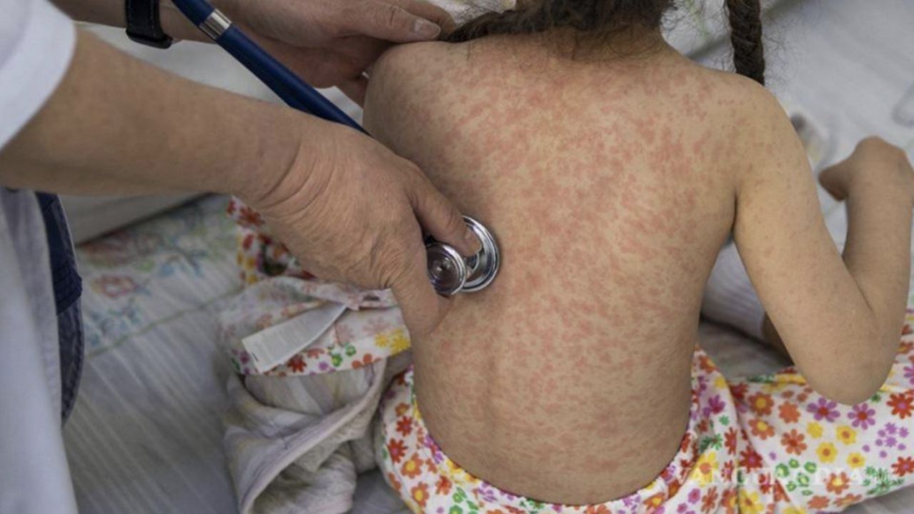 Sarampión en México: 7 estados concentran el 85% de los casos; ¿es obligatorio usar CUBREBOCAS?