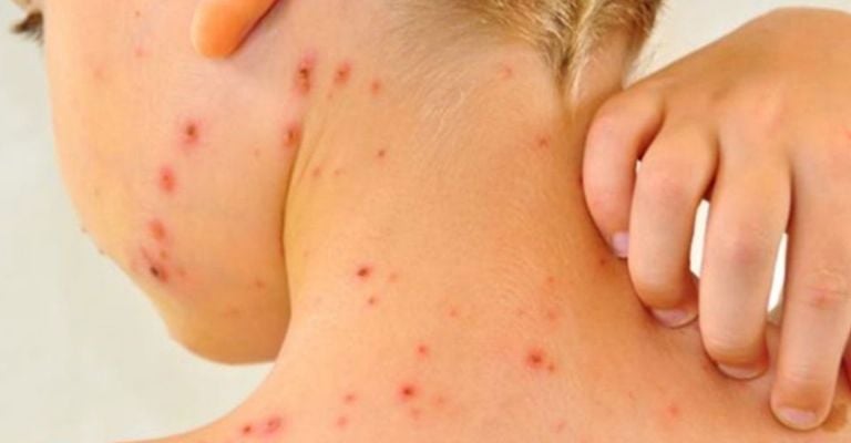 El sarampión es uno de los cinco exantemas clásicos de la infancia, es decir, las típicas enfermedades de los niños que cursan con erupciones o granitos en la piel y fiebre.