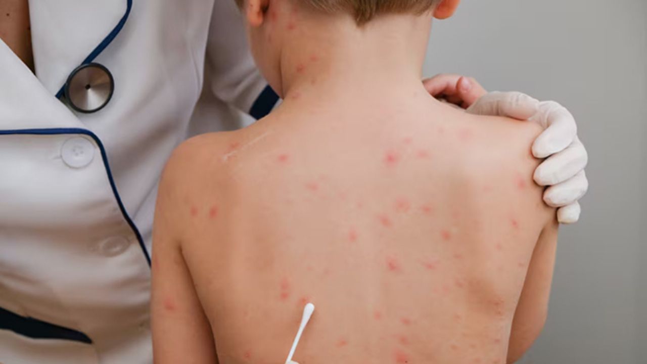 “Casos de sarampión están bajo control en el sur de Sonora”: Salud Municipal de Navojoa