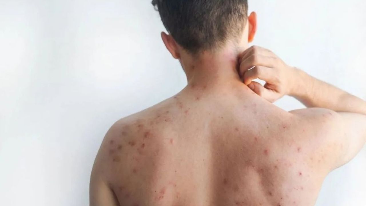 El aumento de casos de sarampión en México deja 32 muertes; la mayoría de las víctimas son niños