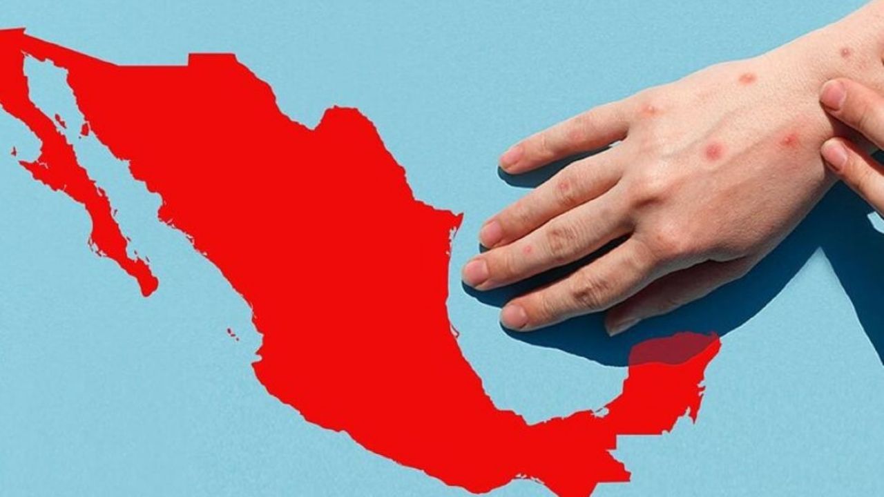 México es el país más afectado por el sarampión en América; se registran más de 14 mil casos