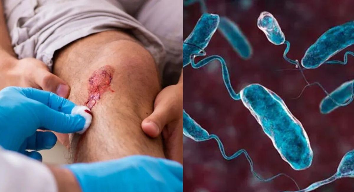 Florida confirma cinco casos de infección por bacteria carnívora 