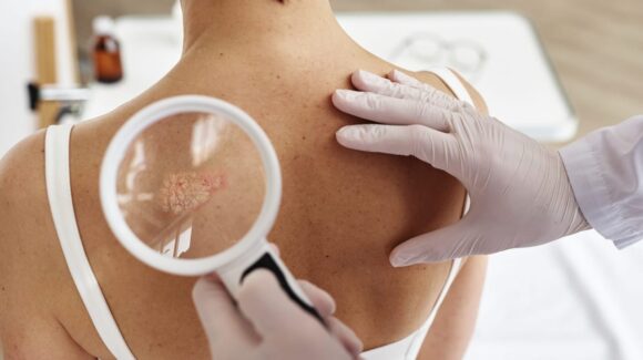 Exposición constante al sol incrementa enfermedades cutáneas; Sonora registra hasta 800 casos de cáncer de piel al año