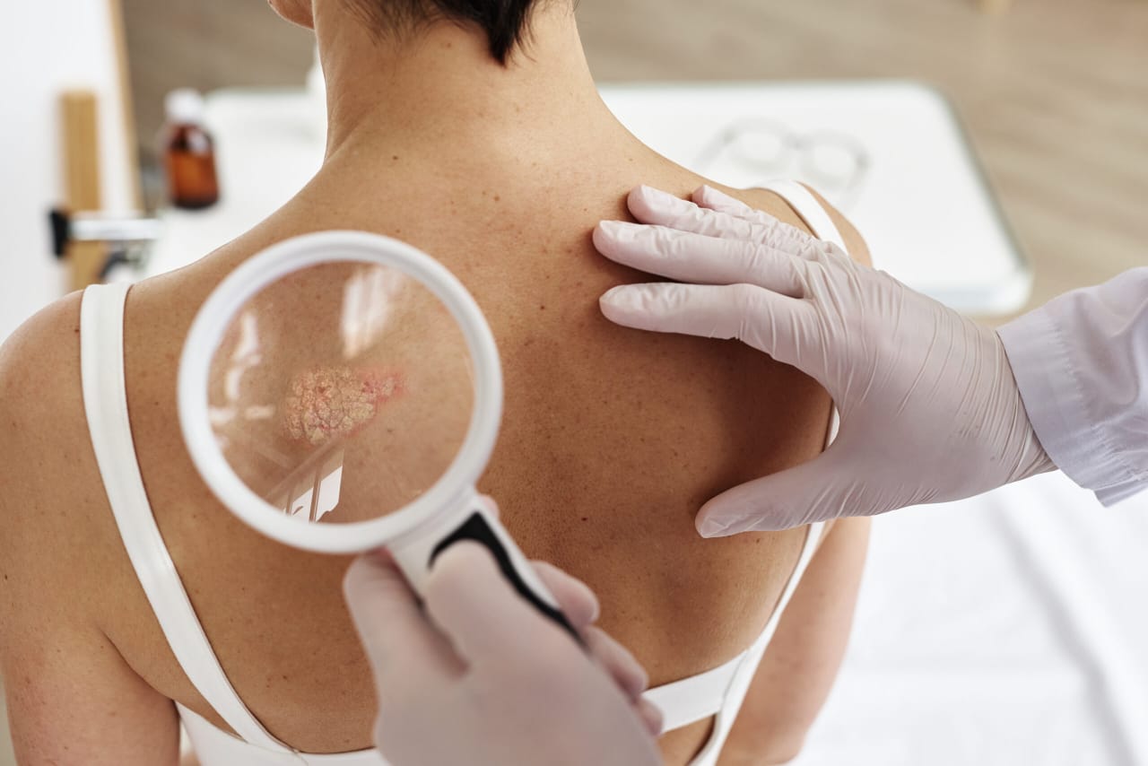 El cáncer de piel y otras enfermedades por la exposición del sol pueden evitarse