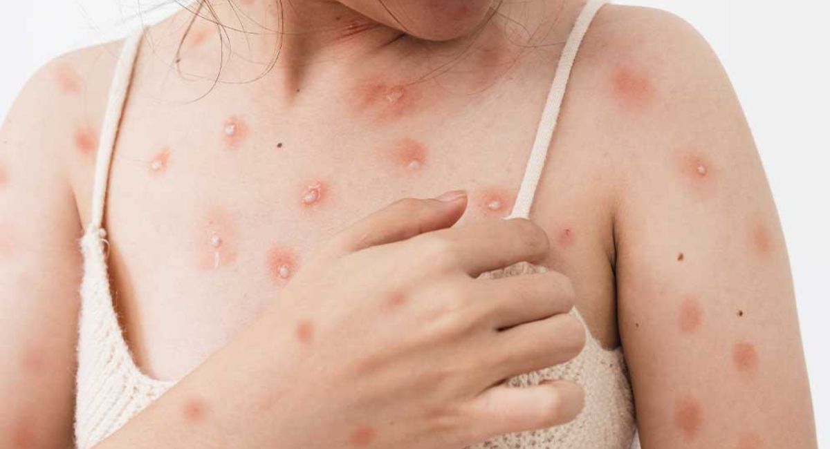 Ministerio de Salud confirma dos casos de viruela del mono en Costa Rica 