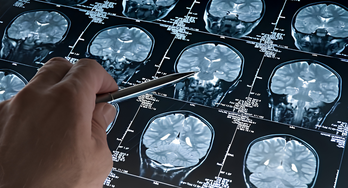 ¡Histórico! Logran retirar un tumor cerebral con ayuda de la Inteligencia Artificial